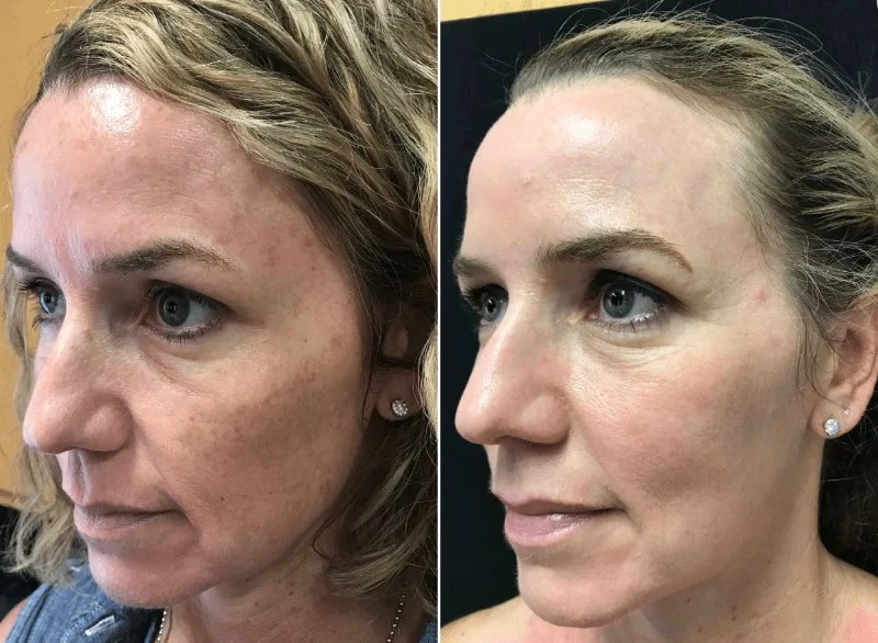 How To Repair Sun Damage In People Living In Humid Climates: A Step-by-Step Guide