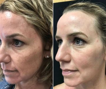 How To Repair Sun Damage In People Living In Humid Climates: A Step-by-Step Guide